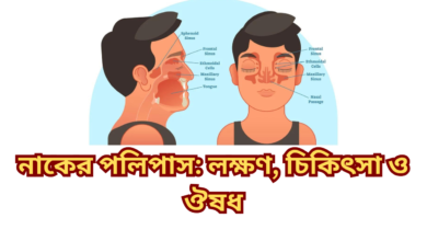 নাকের পলিপাস: লক্ষণ, চিকিৎসা ও ঔষধ